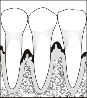 местная или системная??? - Teeth_for_Perio03.jpg